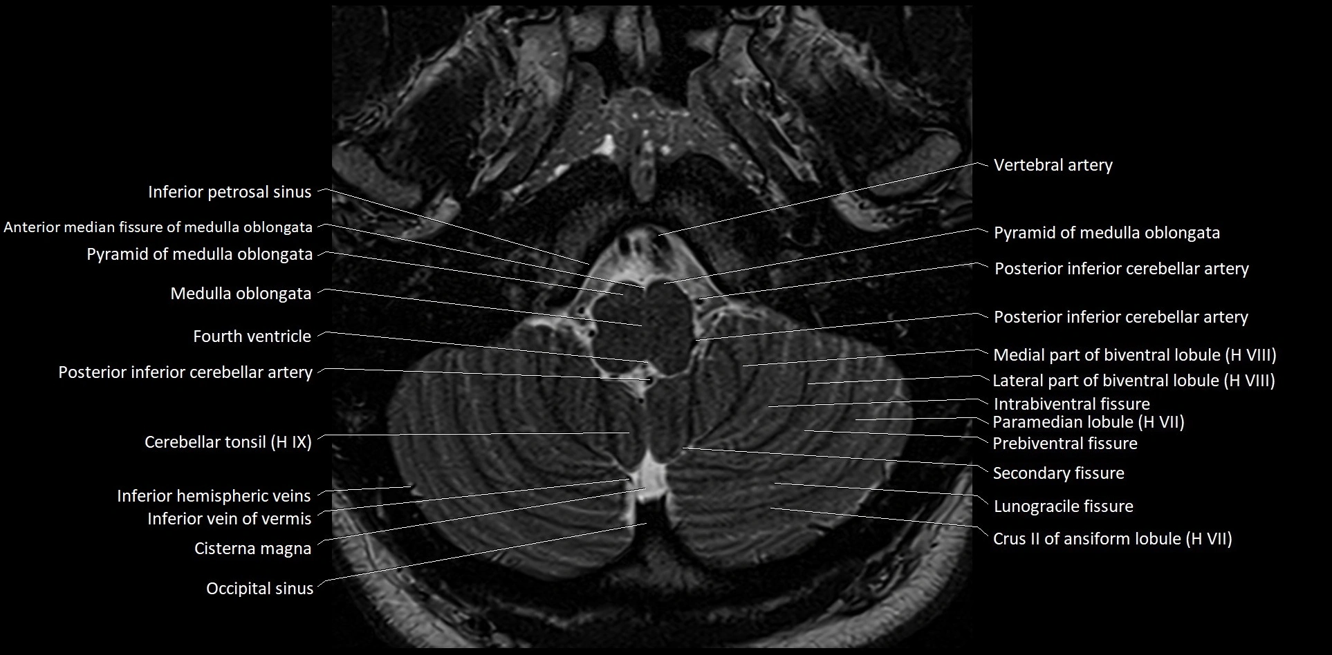 MRI Cerebellar anatomy High-resolution labelled 3T MRI image 6.webp